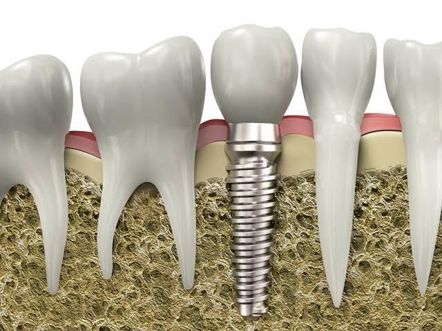 Crown & Bridge Restorations thumbnail